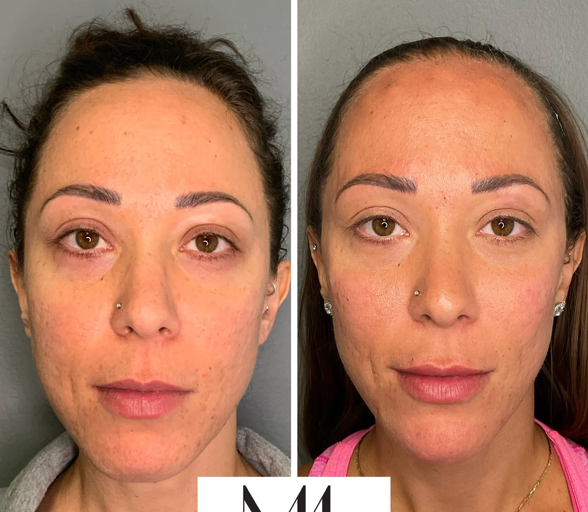 Under-eye tear-trough before and after — real Med 44 patient