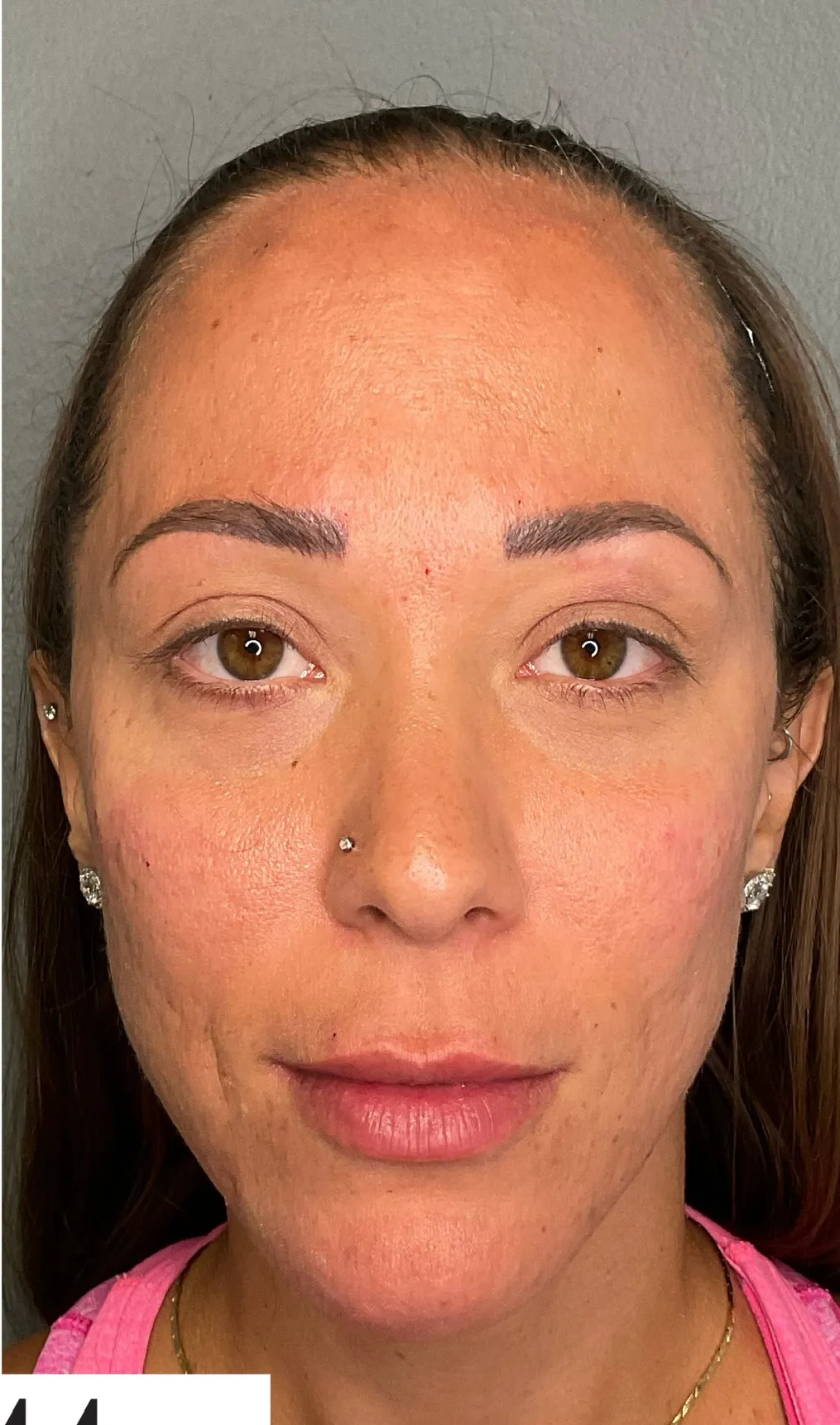 Refreshed, bright under-eyes — Med 44 Arcadia patient